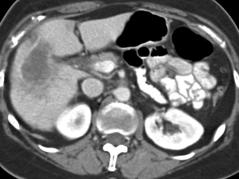 Y90 Post 14 month CT