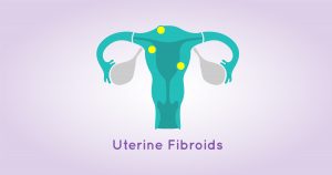 uterine-fibroids101