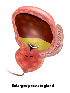 EnlargedProstate_02