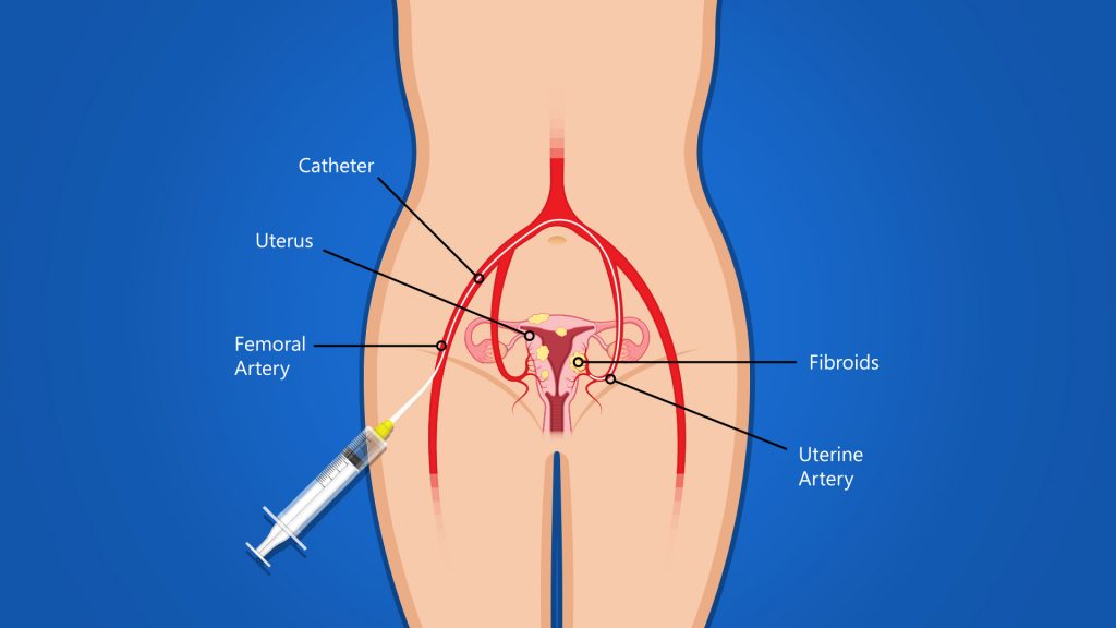 fibroidemobolizationgraphic